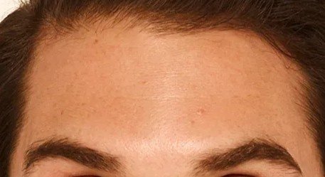 botox_1_after