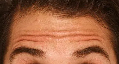 botox_1_before