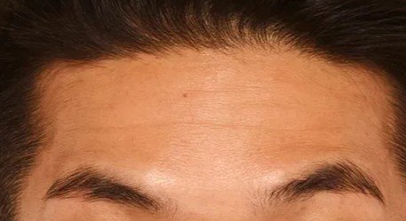 botox_2_after