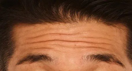 botox_2_before