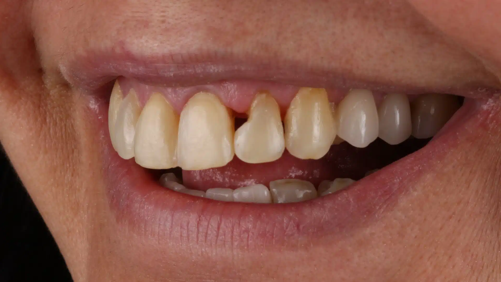 carillas_dentales_spa_1_antes carillas_dentales_spa_1_antes