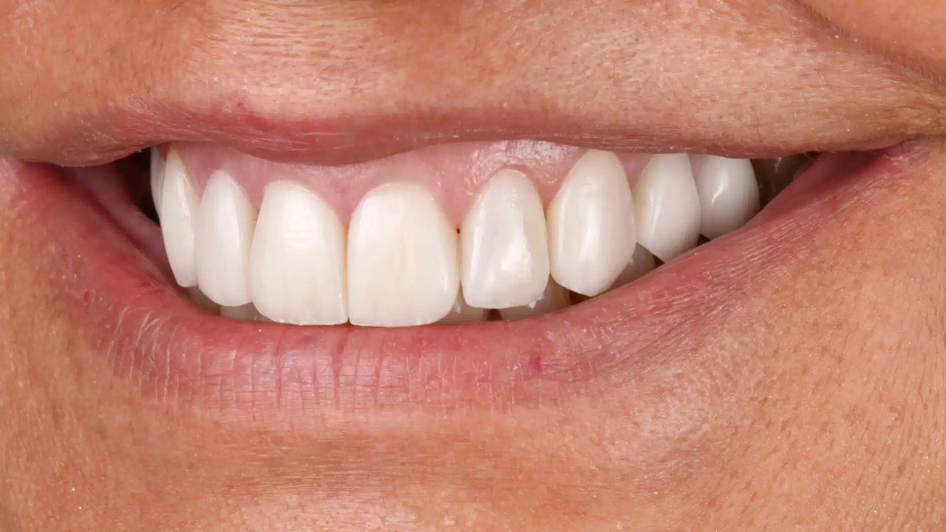 carillas_dentales_spa_1_despues