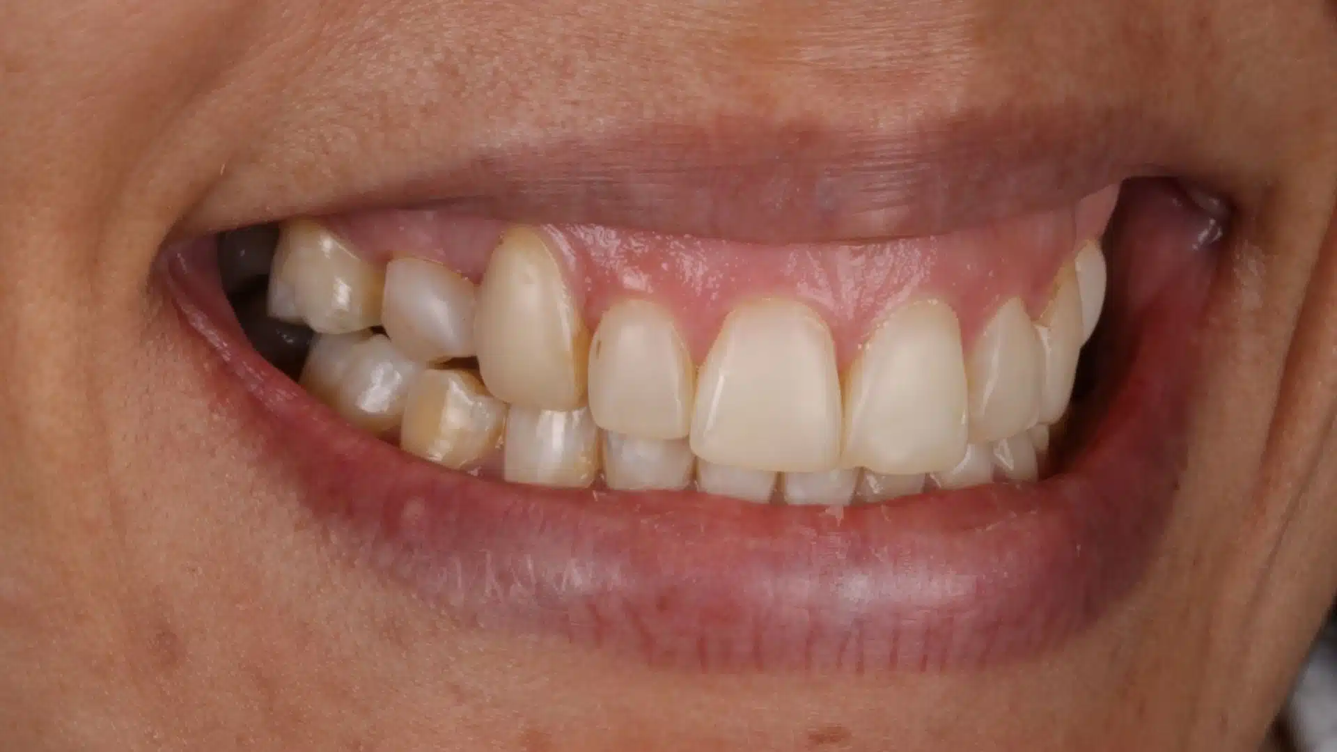 carillas_dentales_spa_2_antes carillas_dentales_spa_2_antes