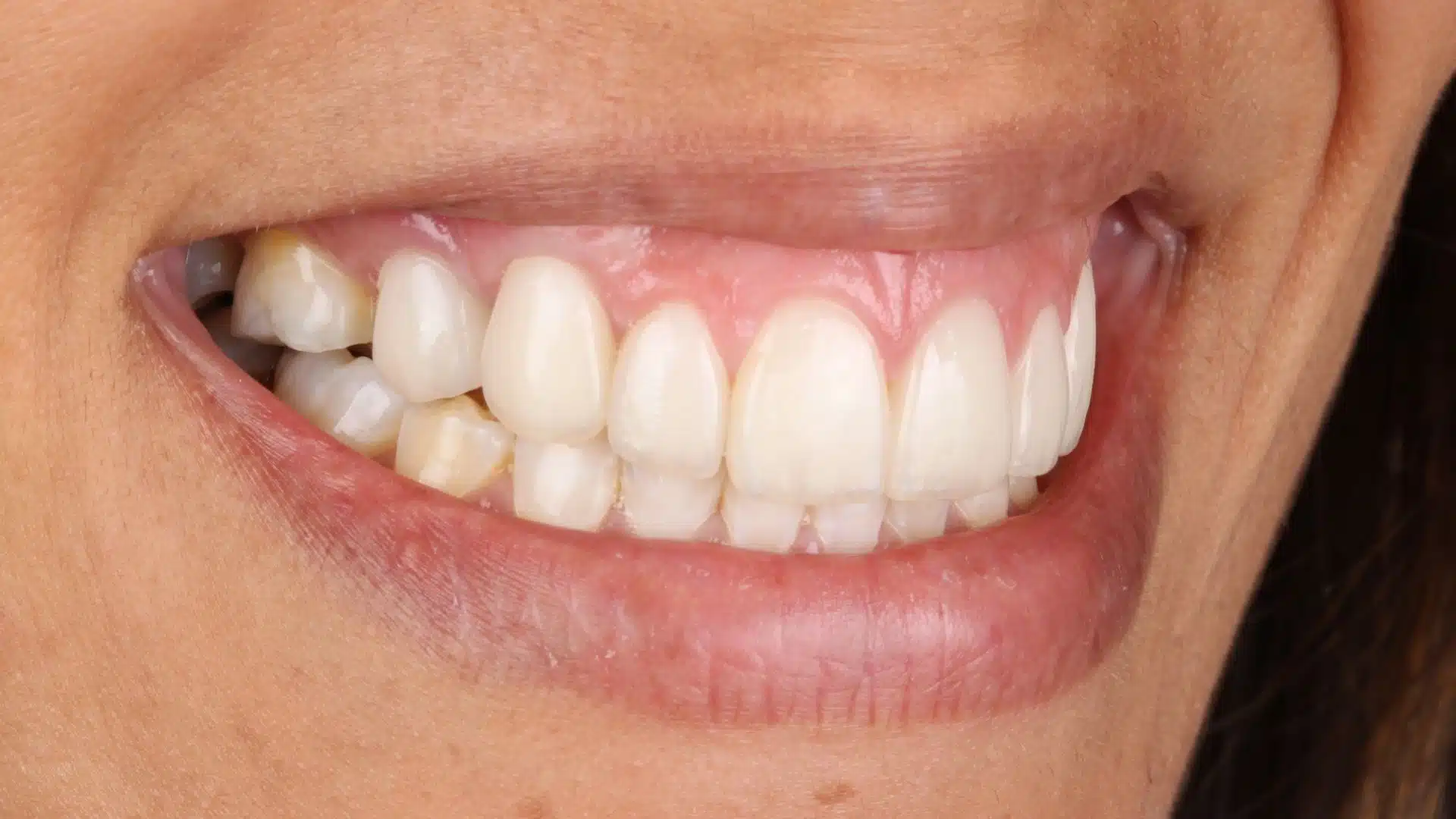 carillas_dentales_spa_2_despues