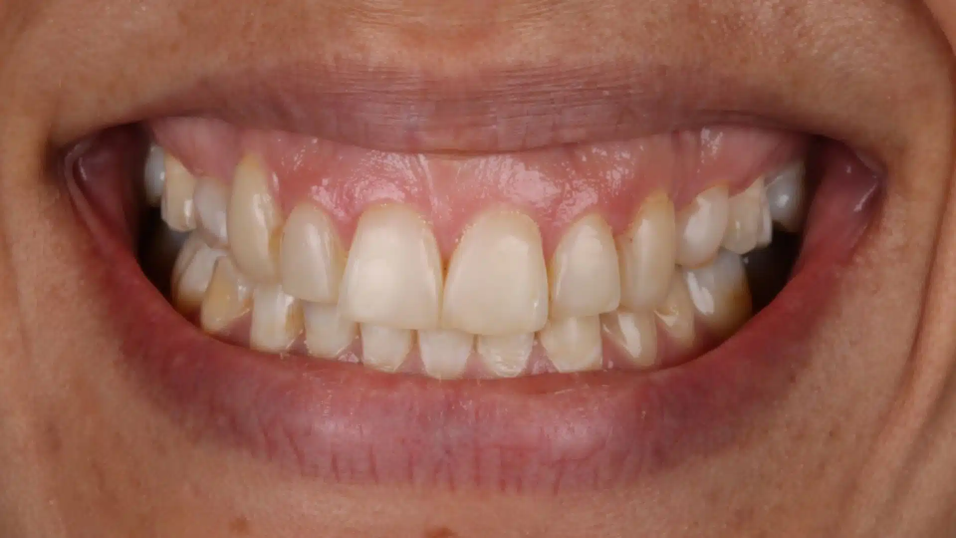 carillas_dentales_spa_3_antes carillas_dentales_spa_3_antes
