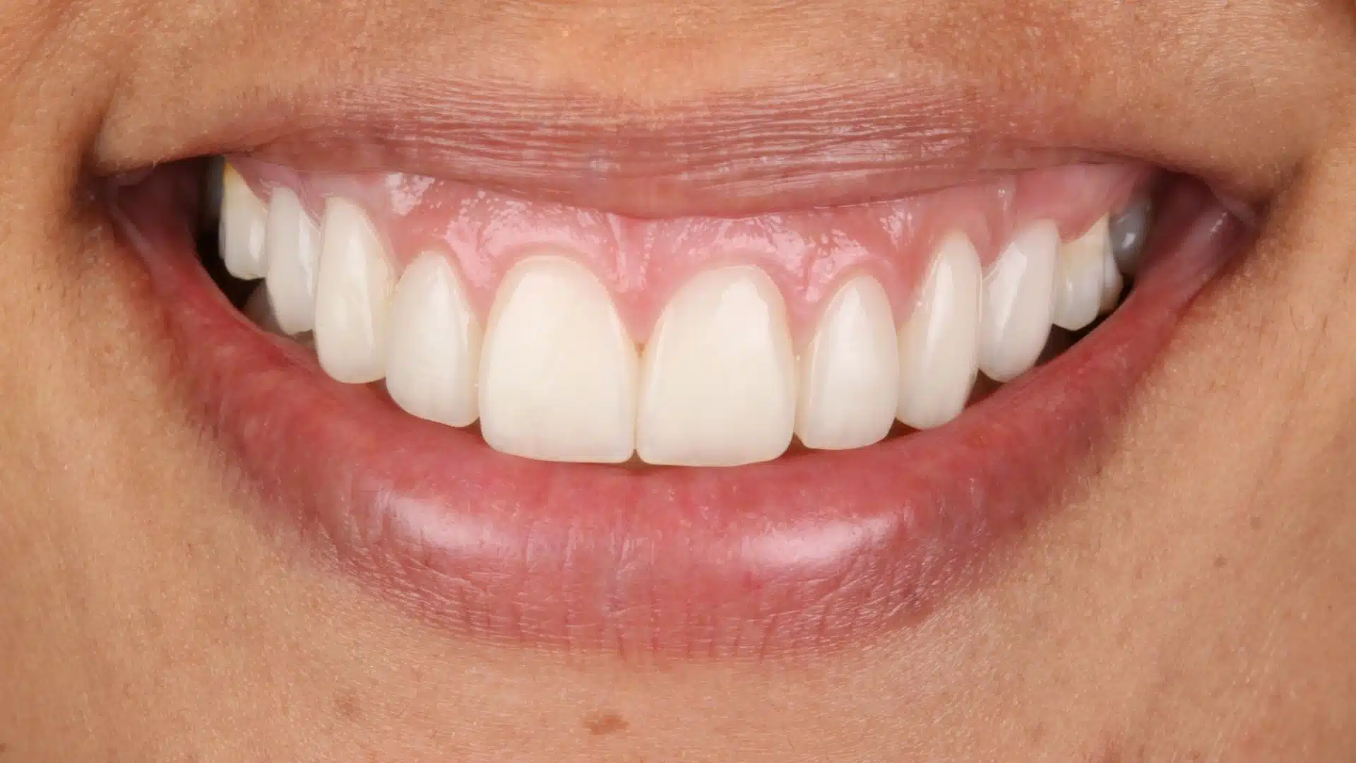 carillas_dentales_spa_3_despues