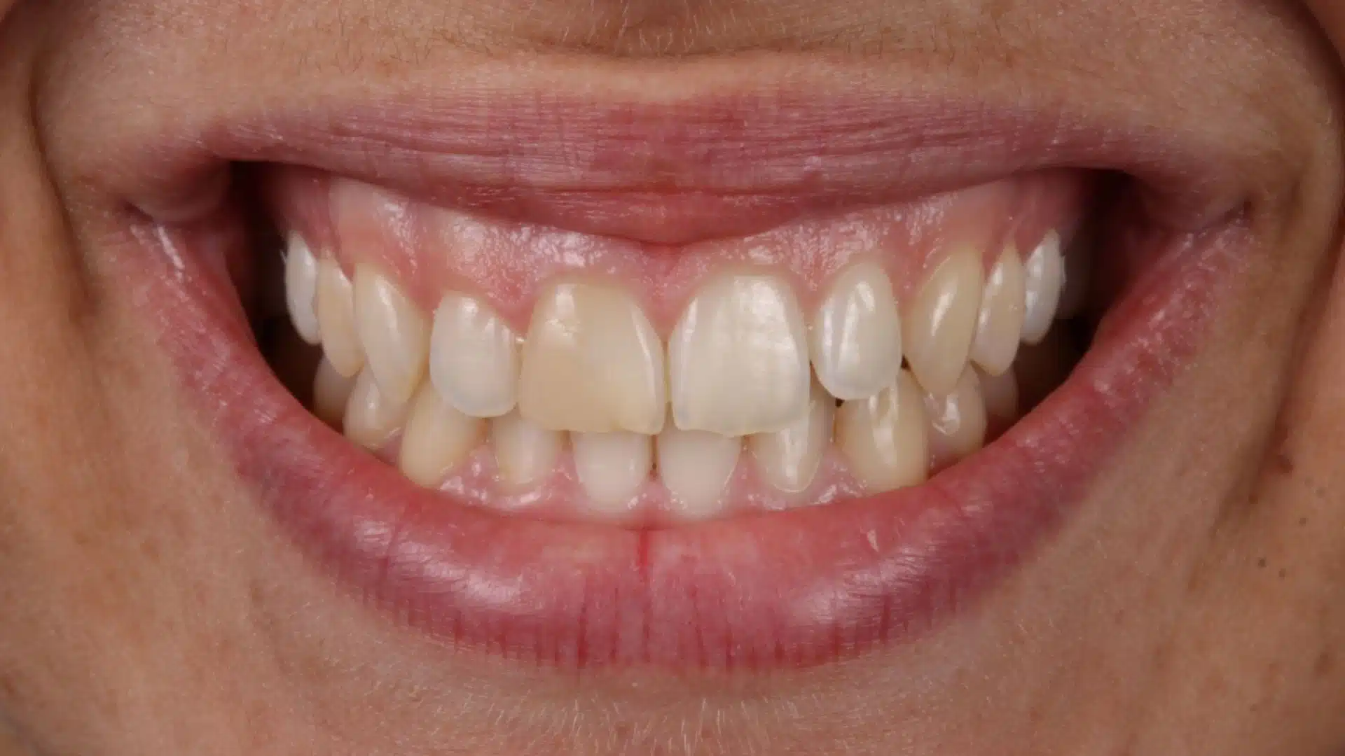 carillas_dentales_spa_4_antes carillas_dentales_spa_4_antes