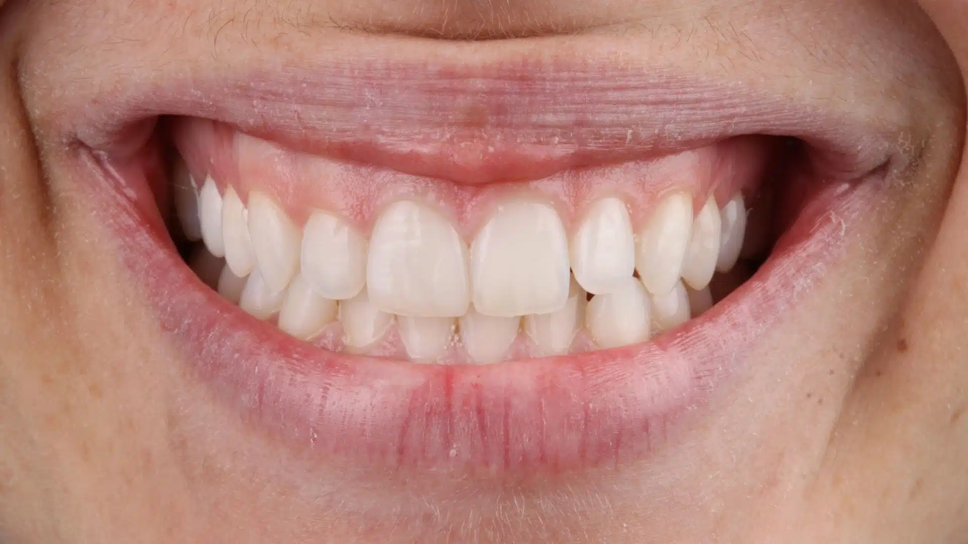 carillas_dentales_spa_4_despues