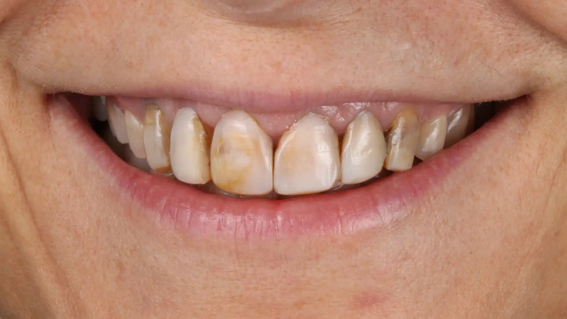 carillas_dentales_spa_5_antes carillas_dentales_spa_5_antes