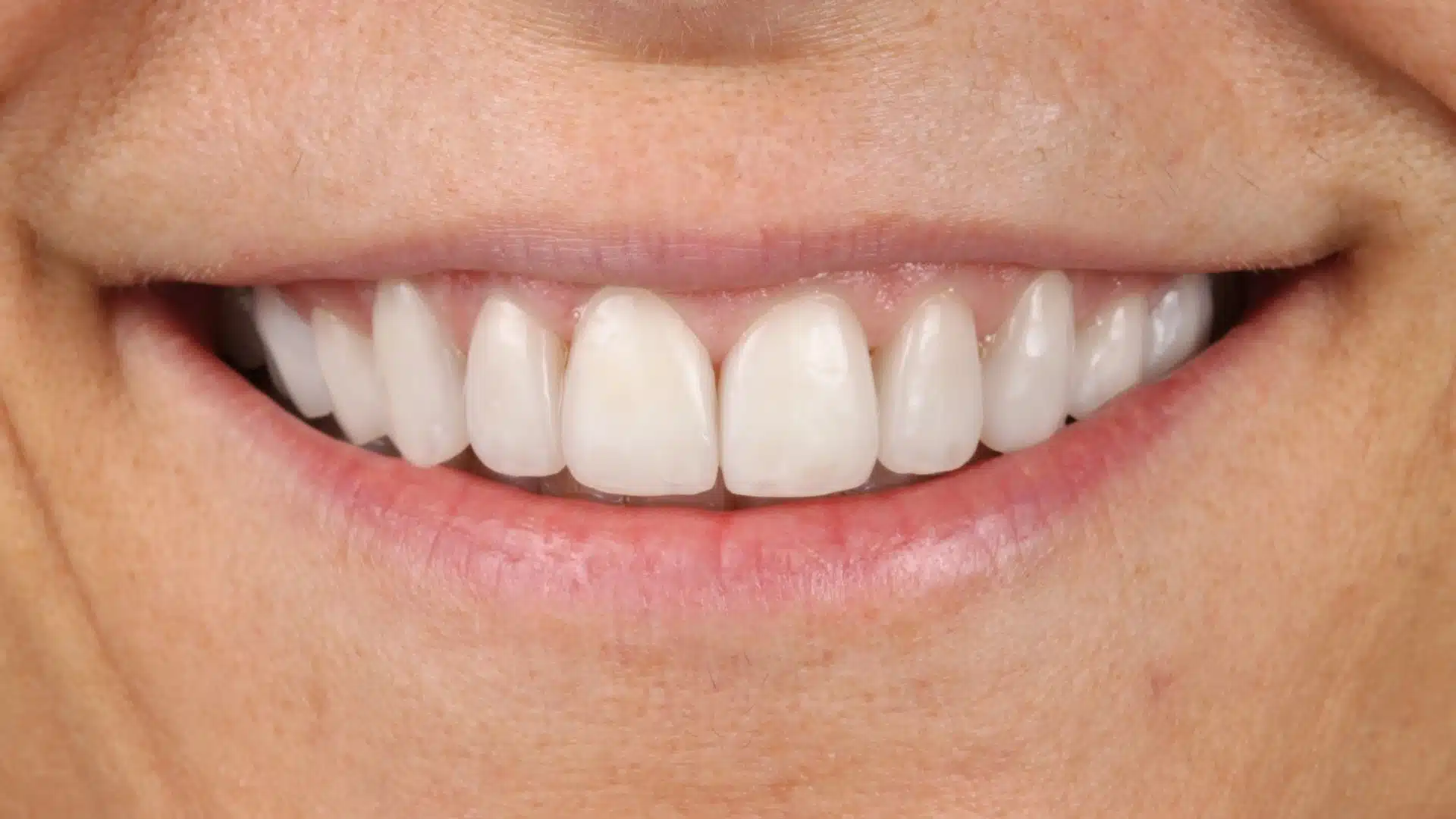 carillas_dentales_spa_5_despues