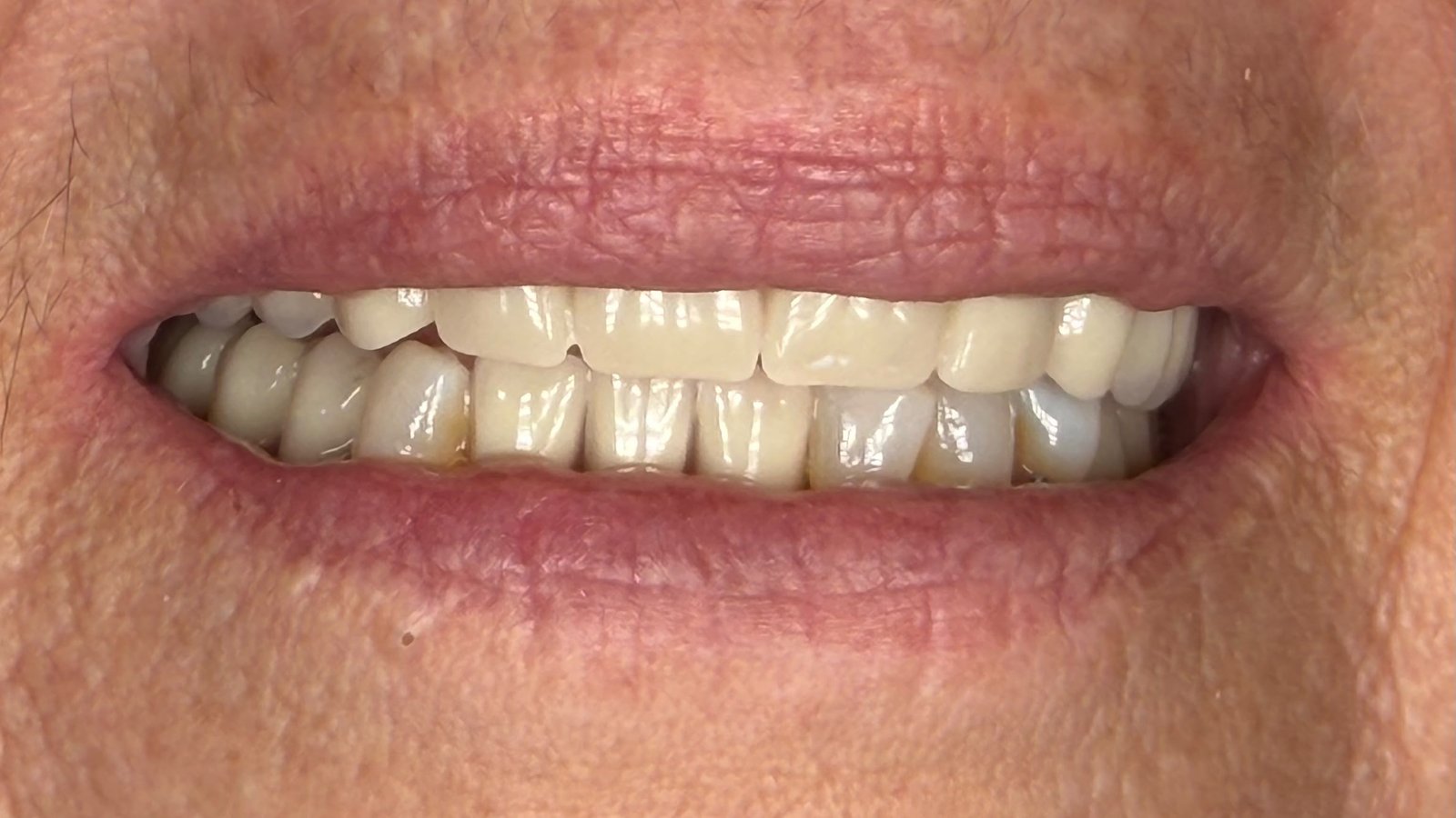 denture_dplus_1_after_v2