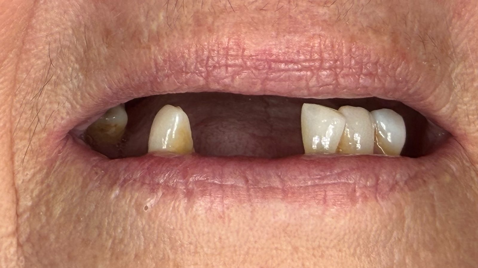 denture_dplus_1_before_v2