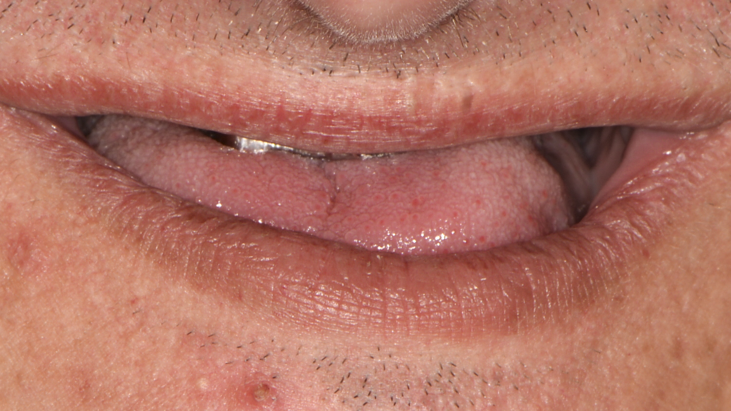 denture_sevilla_1_antes_v2