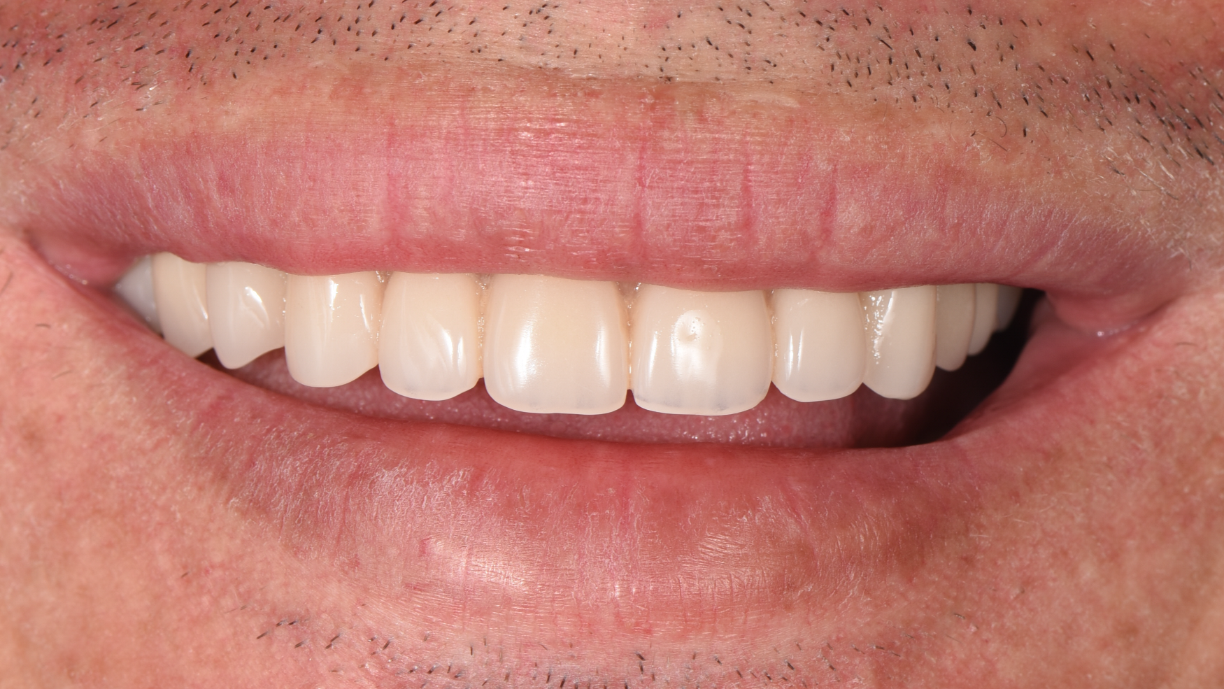 denture_sevilla_1_despues_v2