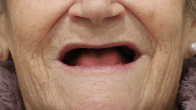 denture_zaragoza_1_antes_v2