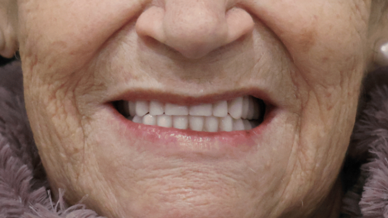 denture_zaragoza_1_despues_v2