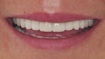 diseno_sonrisa_after_v2