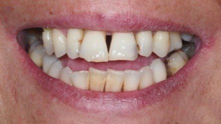 diseno_sonrisa_before_v2 diseno_sonrisa_before_v2