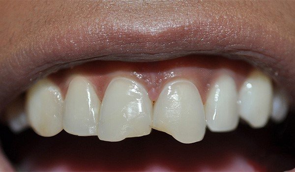 smile_design_1_antes