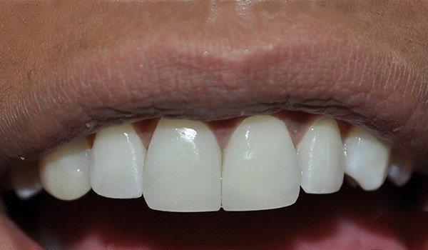 smile_design_1_despues