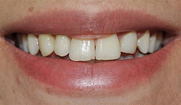 smile_design_2_antes