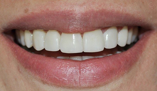 smile_design_2_despues