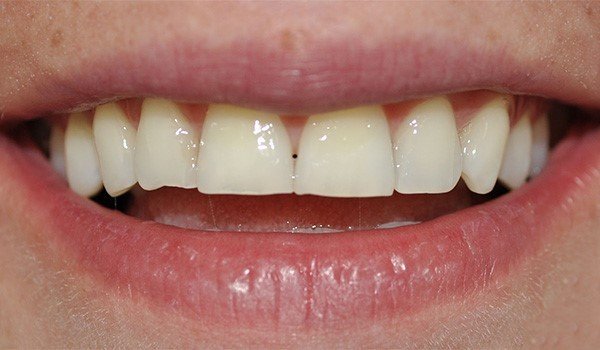 smile_design_3_antes