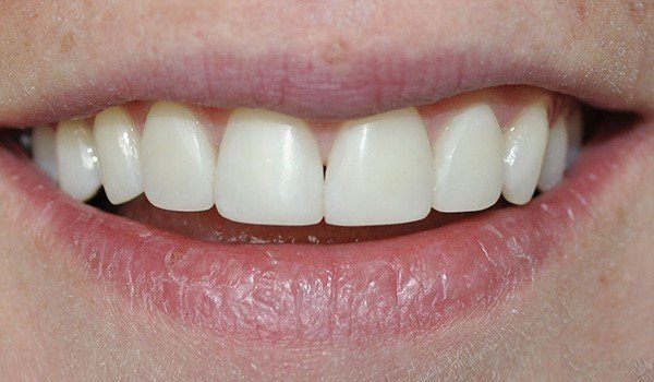 smile_design_3_despues