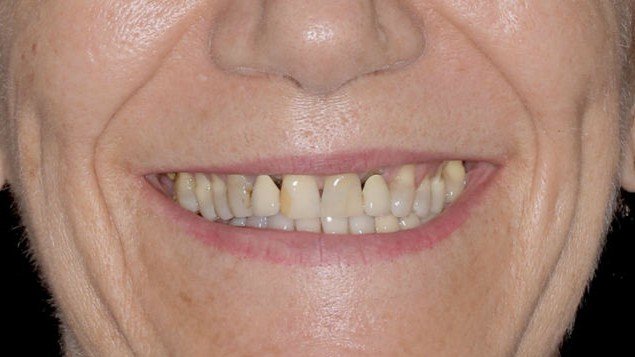 smile_design_sevilla_1_antes