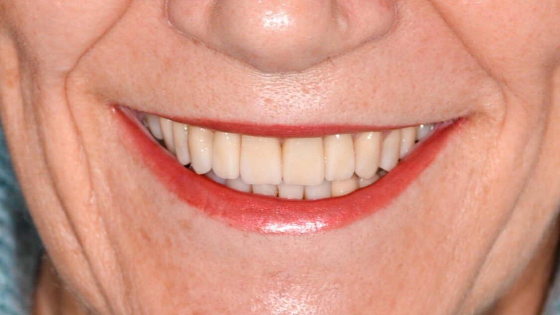 smile_design_sevilla_1_despues
