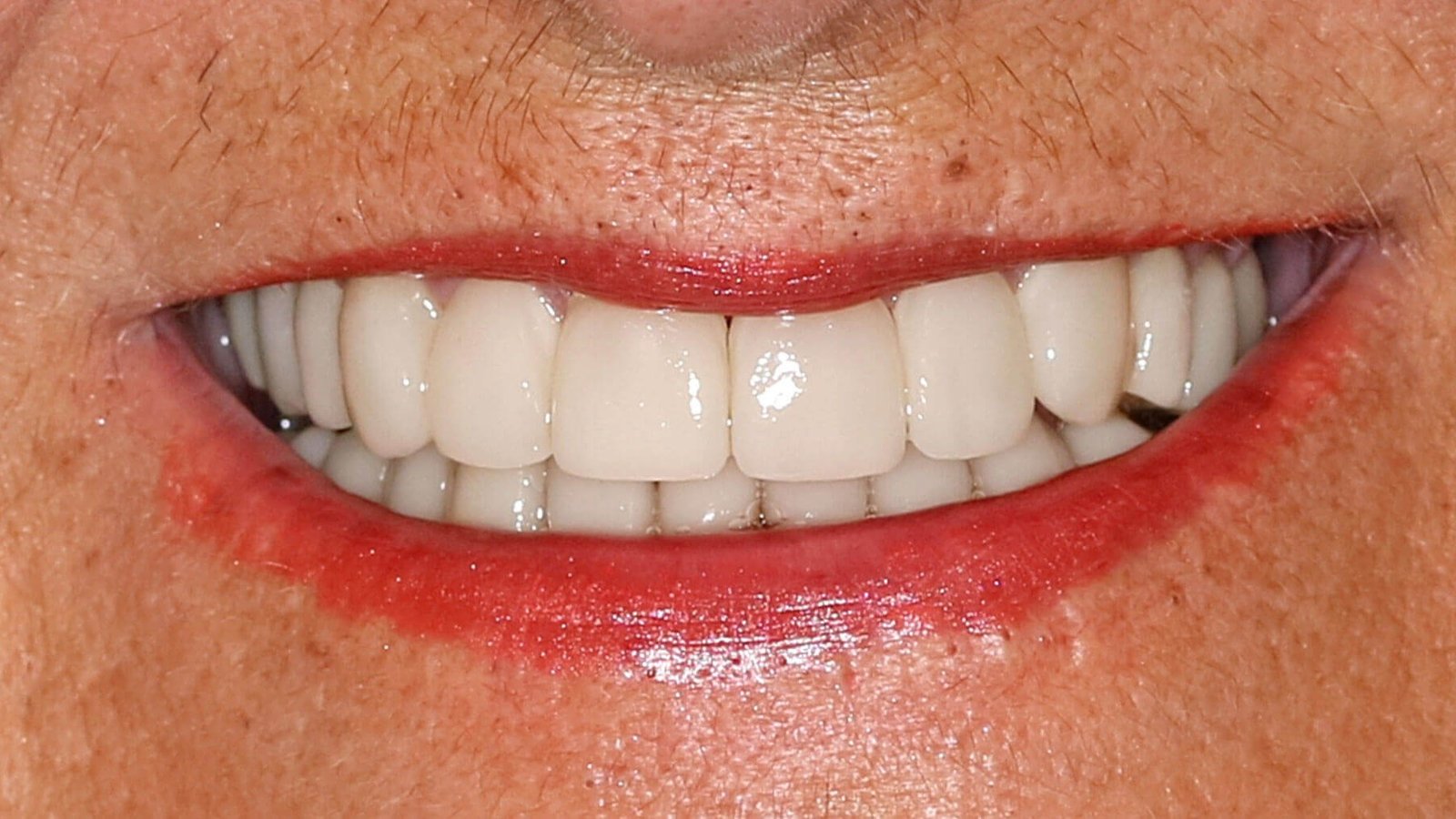 smile_design_sevilla_2_despues_v2