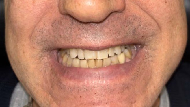 smile_design_valencia_1_antes_v2
