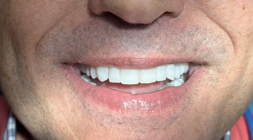 smile_design_valencia_1_despues_v2