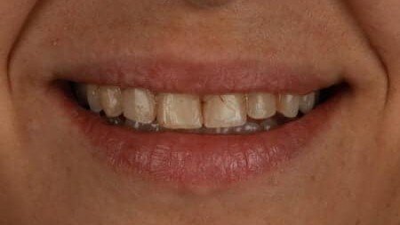 smile_design_veneers_valencia_1_antes