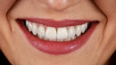 smile_design_veneers_valencia_2_antes