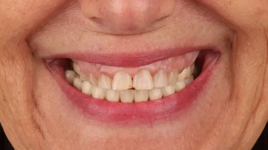 smile_design_zaragoza_1_antes_v2 smile_design_zaragoza_1_antes_v2
