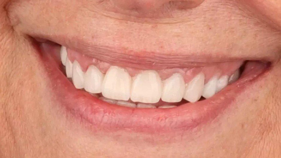 smile_design_zaragoza_1_despues_v2