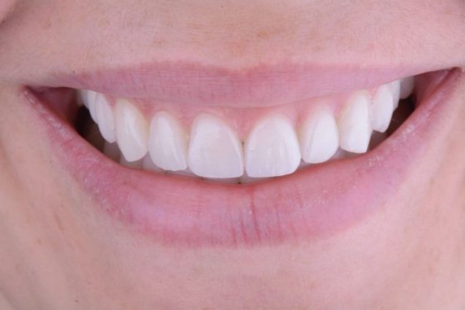veneer_1_after_v2