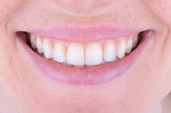 veneer_2_after