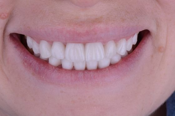 veneer_3_after