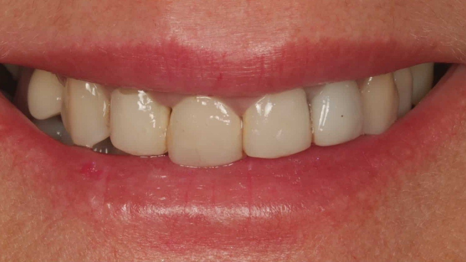 veneers_madrid_1_v2