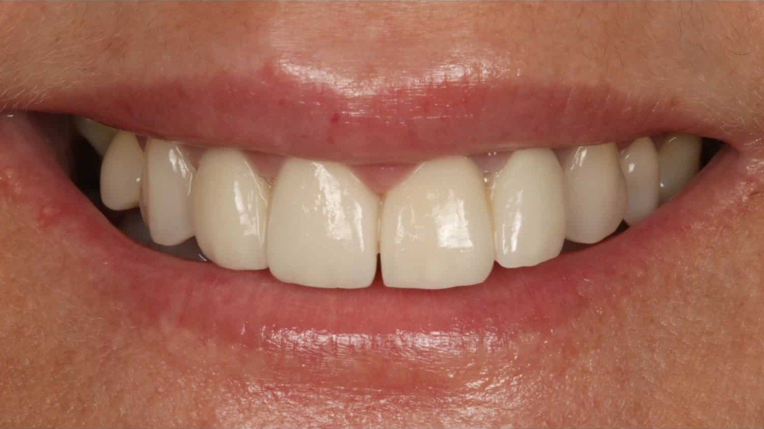 veneers_madrid_1_v3