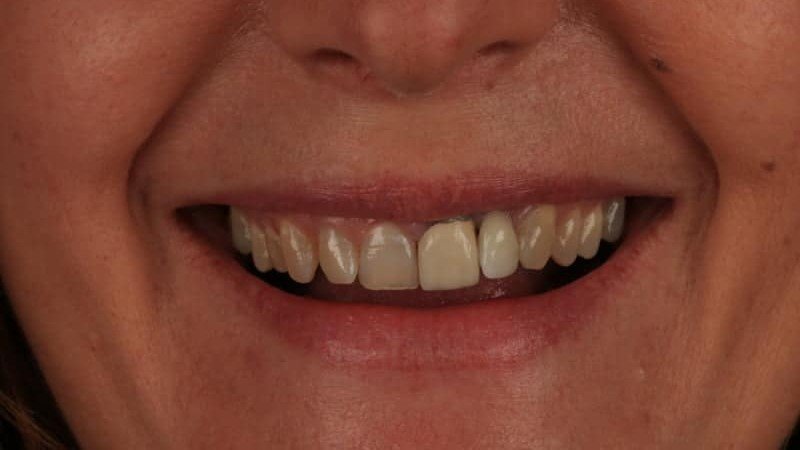 veneers_sevilla_1_antes_v2