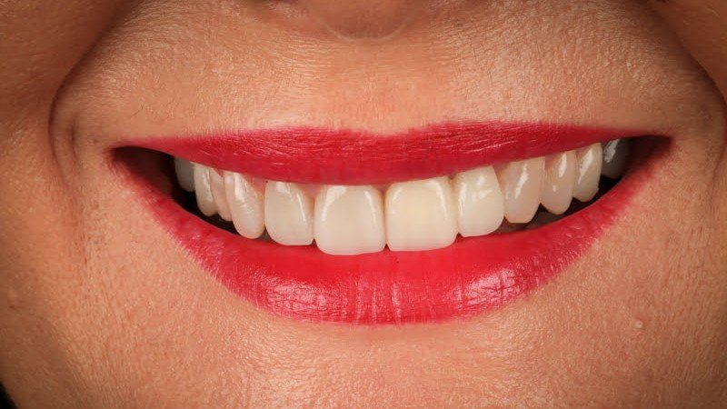 veneers_sevilla_1_despues_v2