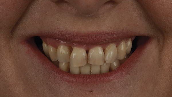 veneers_sevilla_3_antes_v2