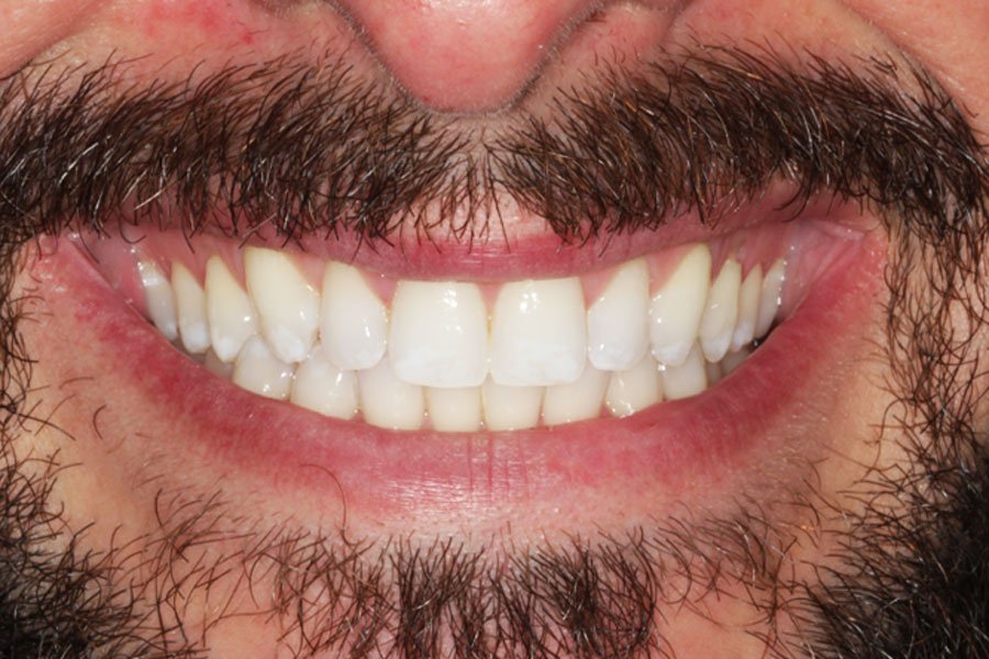 whitening_mallorca_1_despues