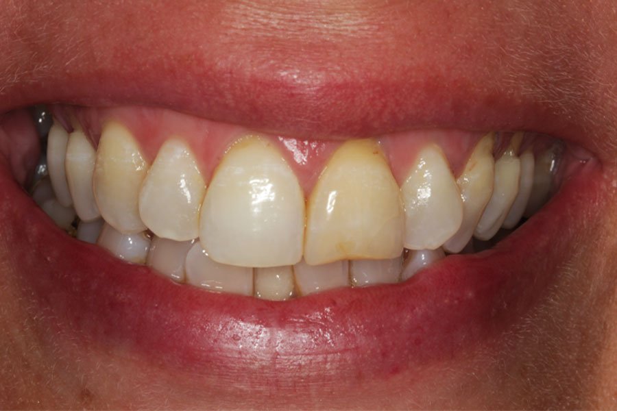 whitening_mallorca_2_antes