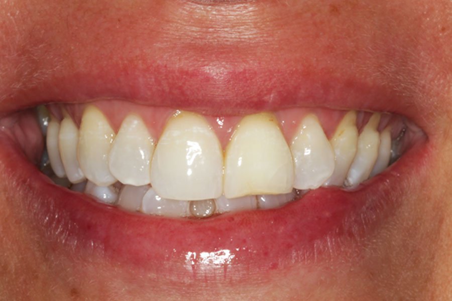 whitening_mallorca_2_despues