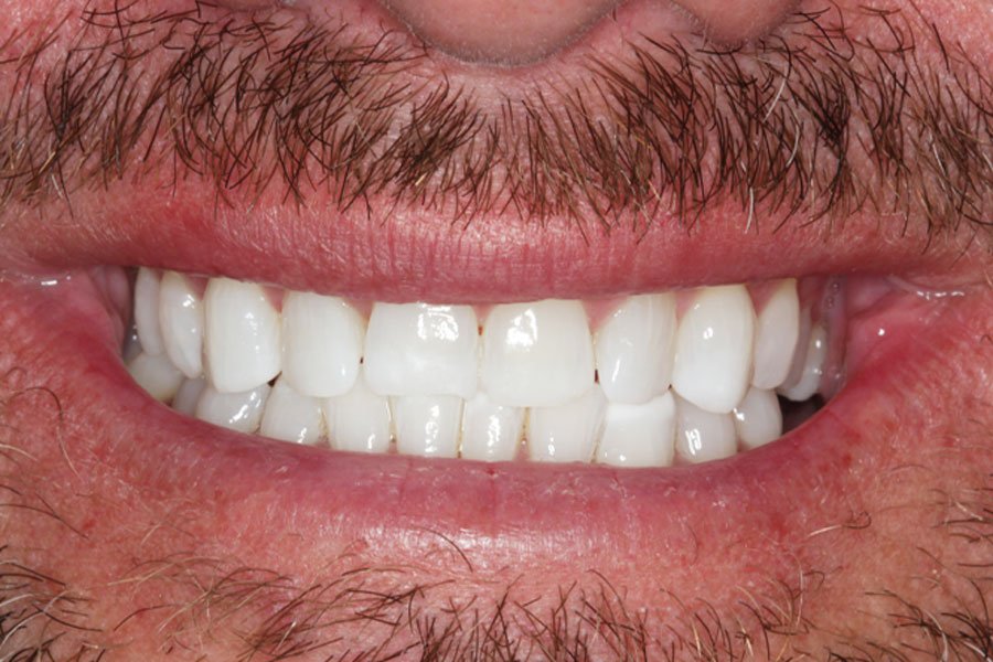 whitening_mallorca_3_despues