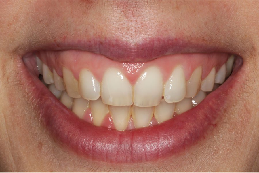 whitening_mallorca_4_antes